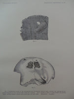 1882 CRANIAL AMULETS Skull Prehistoric Trephining Trepanning Crania Fracture