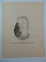 1882 CRANIAL AMULETS Prehistoric Trephining Trepanning Skull Cranium Surgery